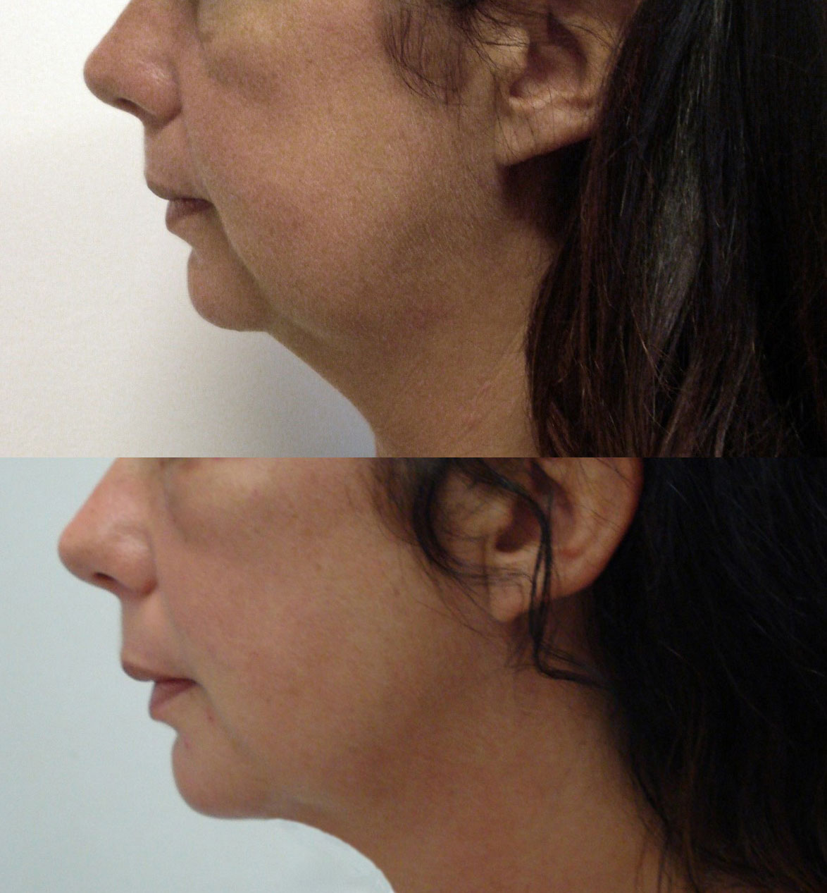 Antes y después - Endolift - Dr. Cassuto - Elena Arnal